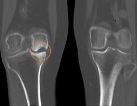 Right knee osteoarthritis