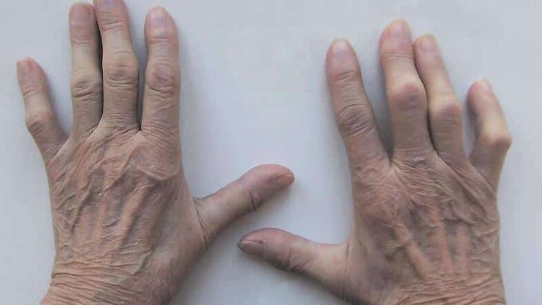 Methods for treating finger joint pain