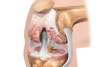 Knee articulation arthrosis