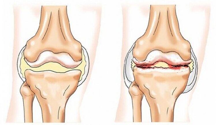Healthy articulation and articulation affected by arthrosis